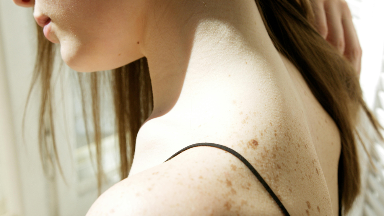 A close-up view of a woman's shoulder and upper back covered in natural freckles.