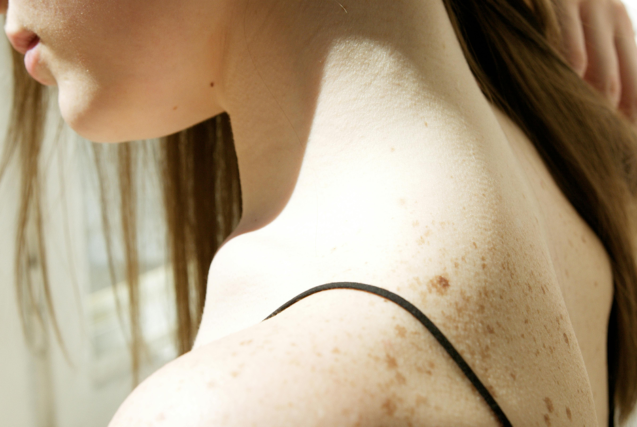 A close-up view of a woman's shoulder and upper back covered in natural freckles.