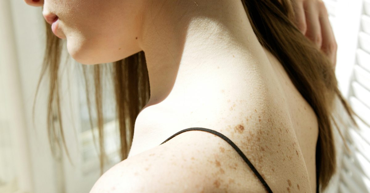A close-up view of a woman's shoulder and upper back covered in natural freckles.